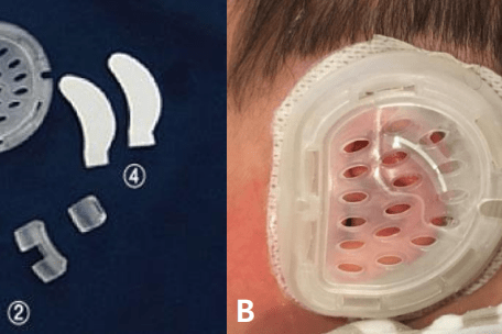 【全球最新爱韦尔研究荟萃】—奥地利专家学者表示耳模矫正可降低