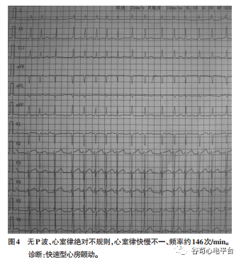 常见心电图危急值的识别与诊断