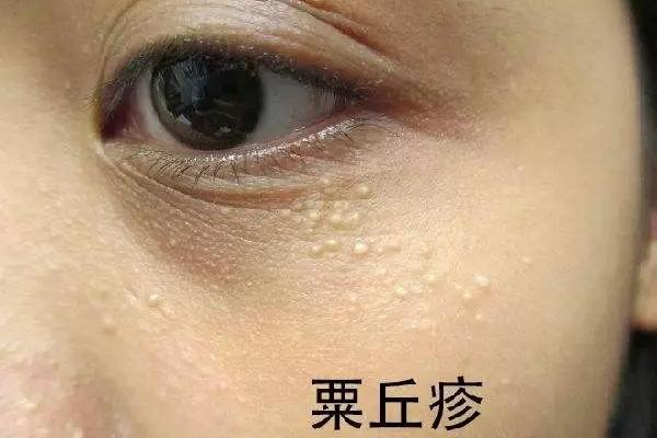 脂肪粒?汗管瘤?還是粟丘疹?