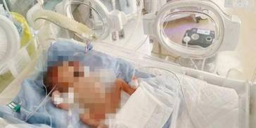 奇迹！安徽750克“掌心宝宝”83天生命闯关