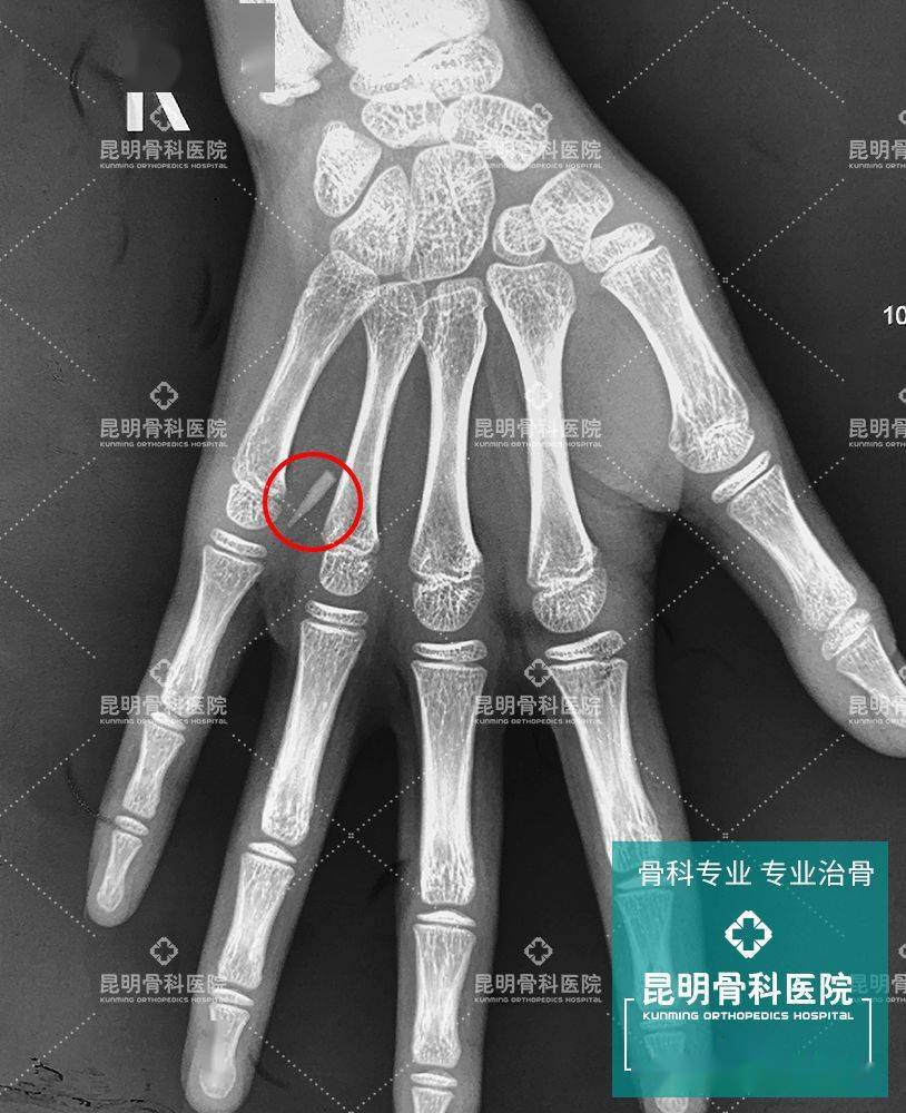 9岁女孩手掌刺痛,X光下拍到惊人一幕-搜狐大视野-搜狐新闻