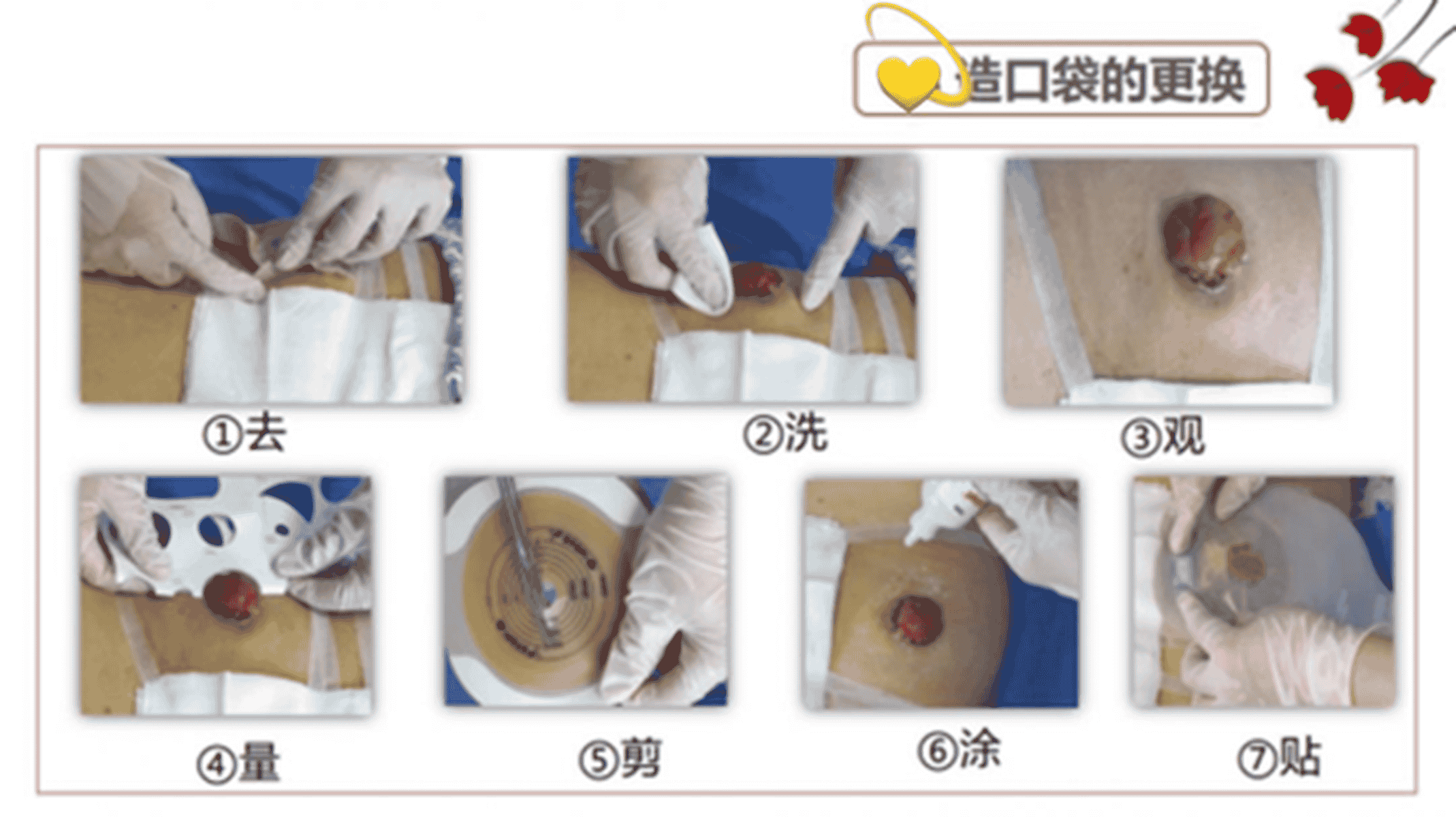 【健康科普】造口患者居家宝典