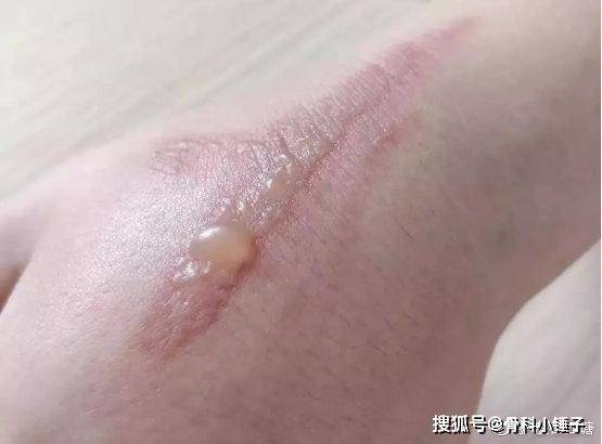 突然出现的隐翅虫皮炎_手机搜狐网