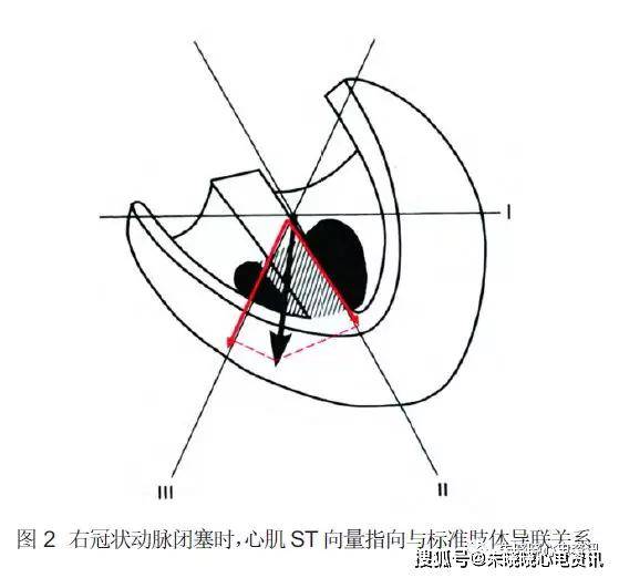 (1)右冠狀動脈閉塞引起的st 向量的改變,較左迴旋支閉塞所引起的改