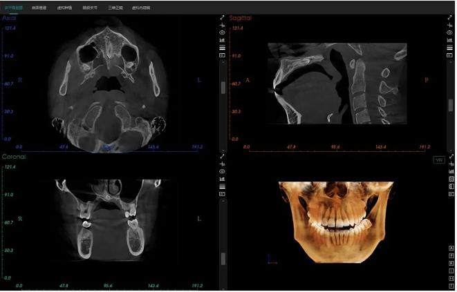 根尖炎症上颌窦形态观察颌面外伤楔状缺损牙周病智齿买61买买69买