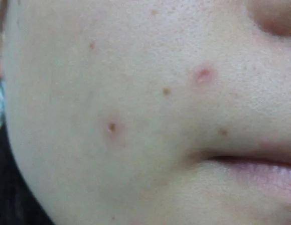 水痘印能做什么管理?该用哪些产品?|皮肤管理