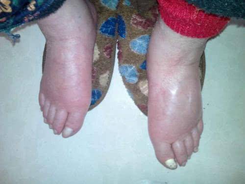 脚肿是什么原因 来自搜狐网