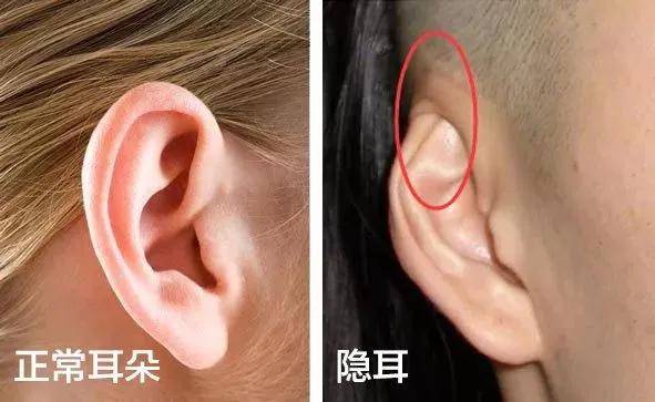尺度整容医院耳朵也可以整形常见的耳整形手术有哪些