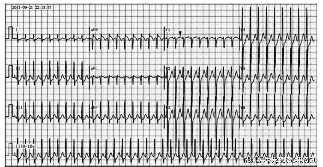 窄qrs波心动过速的远程心电诊断