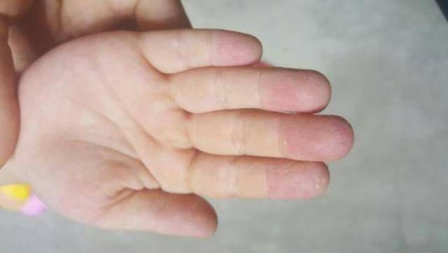 我们双手手心,正常情况下,是比较红润的,如果中指的手指肚上面,有明显