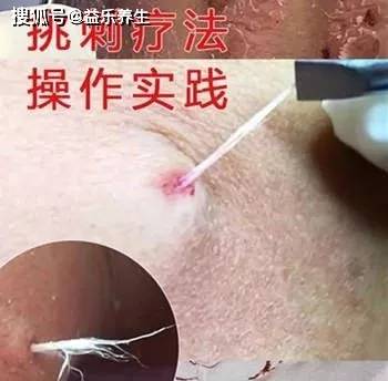 羊毛疔是什么病?挑羊毛疔挑出来的是什么?对人体的危害!
