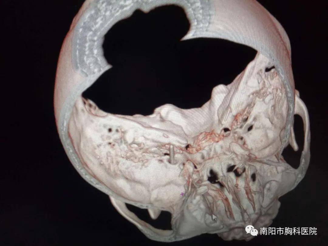 數字減影下時時監測,將細小的射頻針通過卵圓孔送入三