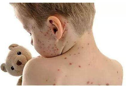 做好预防很关键,让孩子远离水痘!