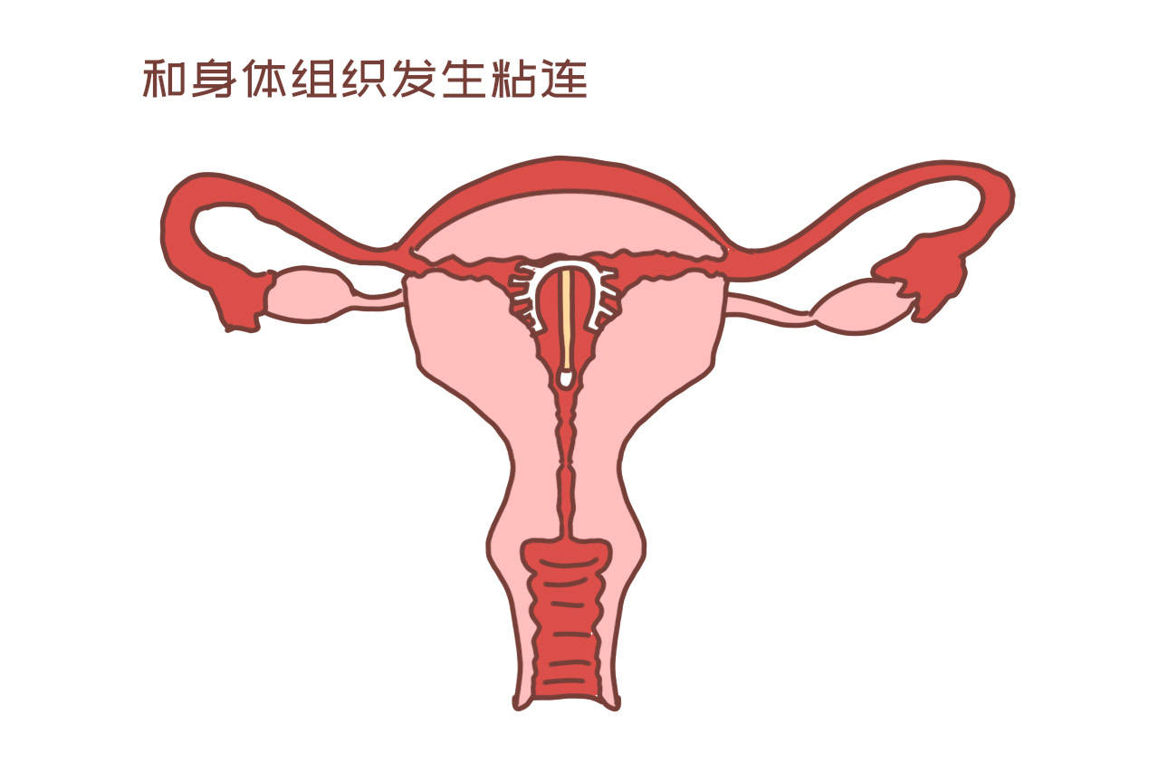 女性上环过程子宫图片