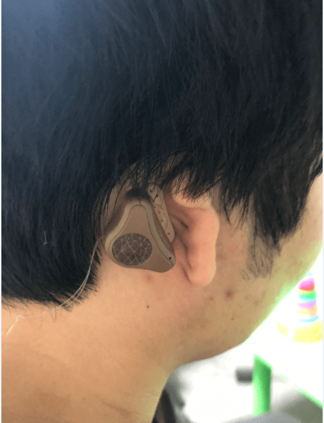 非植入骨导助听器图片