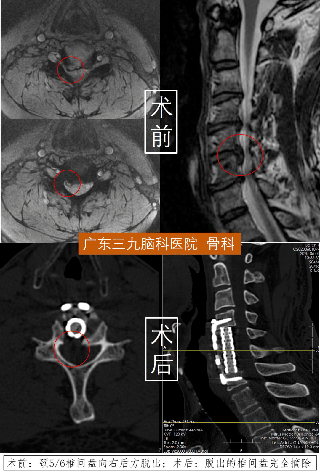 c5/6,c6/7間盤摘除 脊髓神經減壓 c5,c6椎體次全切 鈦籠植骨融合鈦板