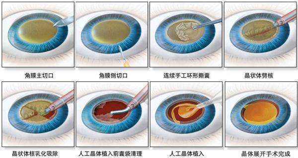 角膜切开手术相比,其安全性已经发生了质的飞跃,可以说激光治疗近视