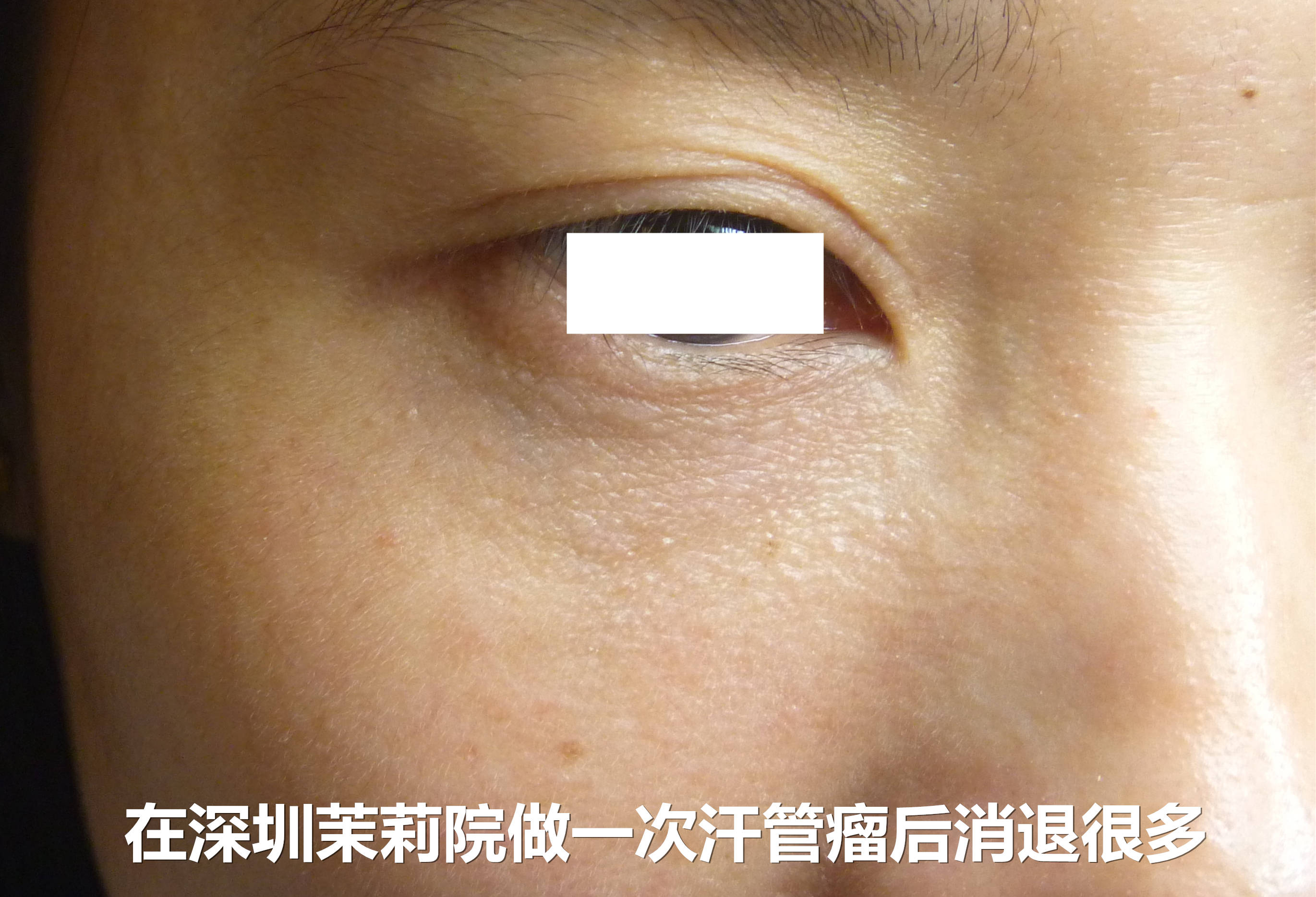 用了男朋友姑妈这个方法,才去除掉汗管瘤