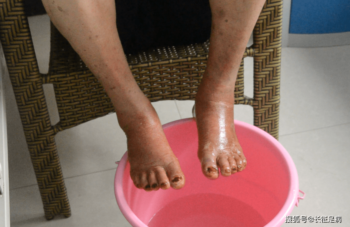 这是一种普遍的现象,很多糖尿病人会感觉有下肢灼烫感,就像是有火烧火