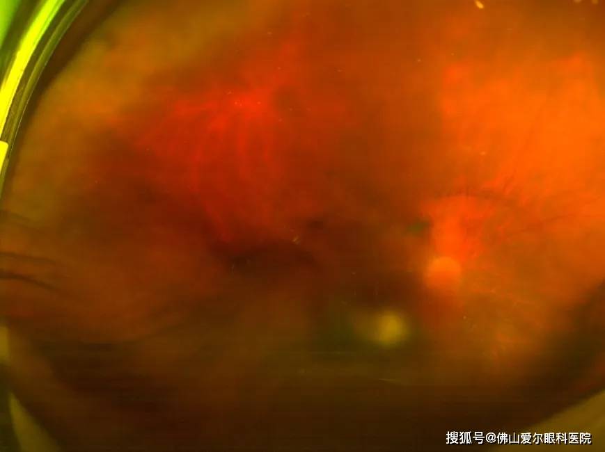 右眼玻璃体大量积血,仅可见上方周边网膜及部分视乳头