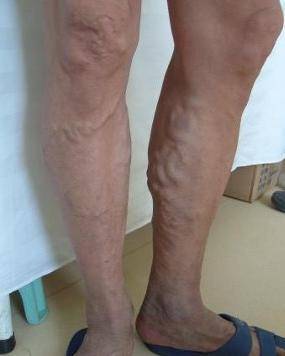 一团一团的鼓出表面的青筋血管,还有的朋友小腿的皮肤颜色都变了,暗红