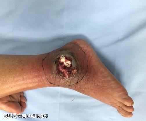 痛风科医生看了竟这么说!