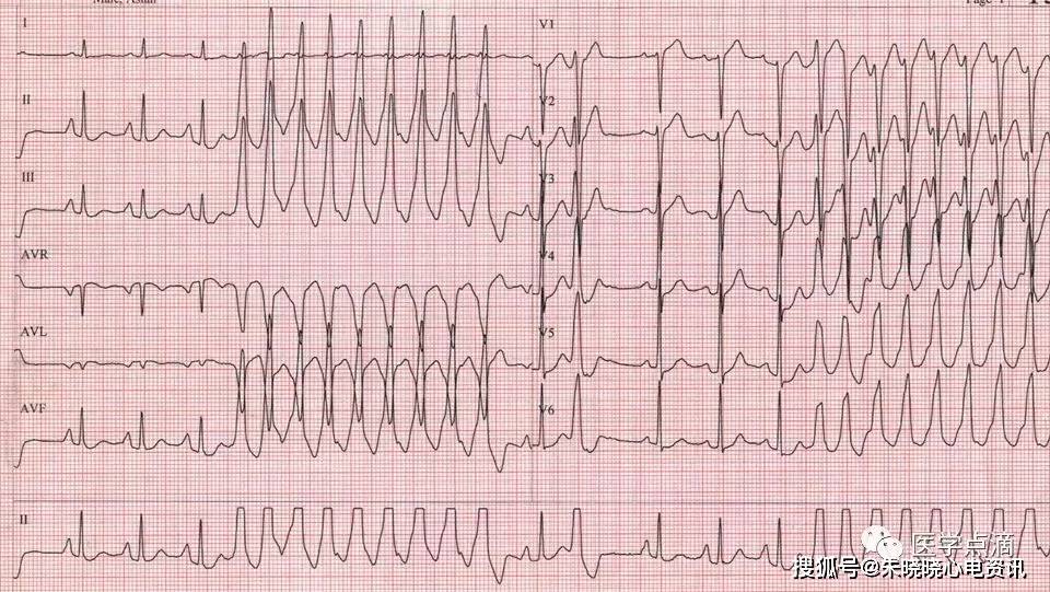 典型室速心电图图片图片