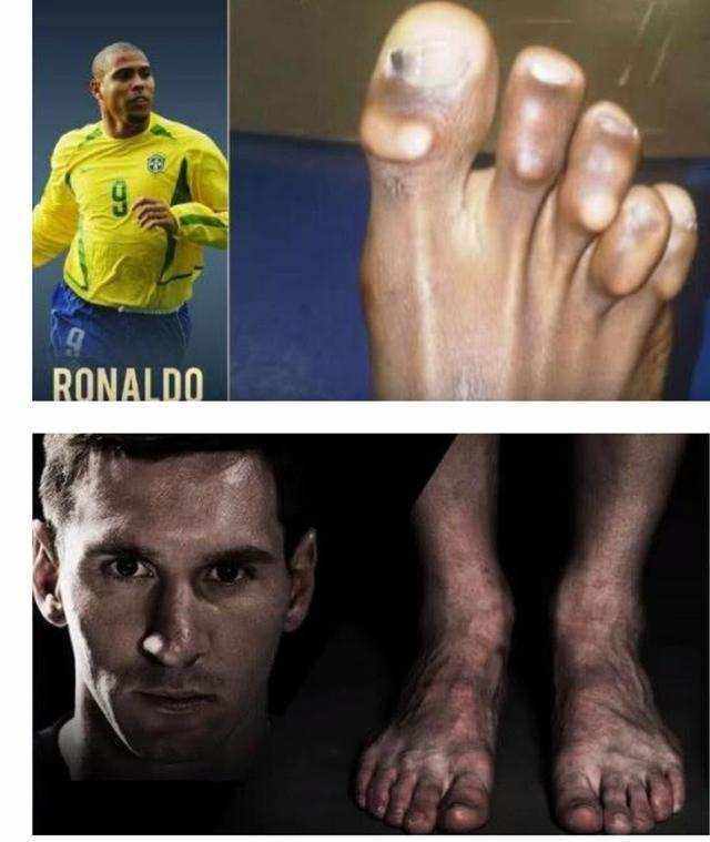 继续比赛,长此以往导致了科比手指的眼中变形