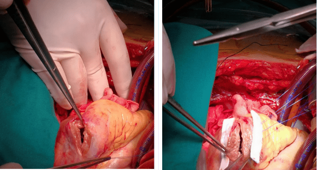 室壁瘤是怎么形成的?如何治疗?——心外科专家权晓强