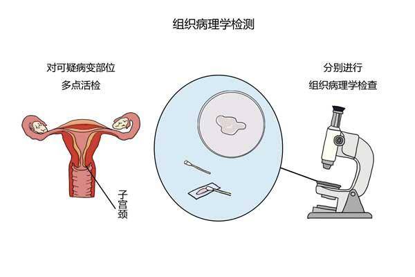 宫颈癌理你有多远?可以做这几种检查,帮你筛查发现