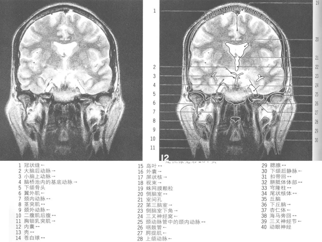 影像基礎mri顱腦冠狀位解剖圖譜