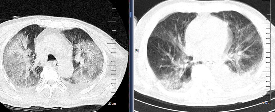 有趣病例:雙肺瀰漫性病變,肺水腫or肺部感染?