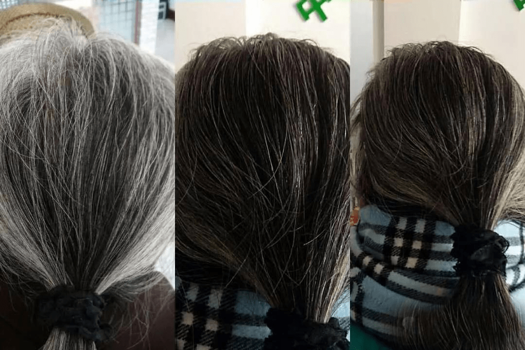白转黑案例分享,拒绝染发剂~白转黑有办法了