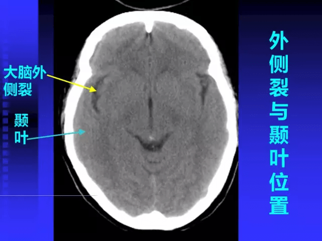 入門頭顱mri讀片知識