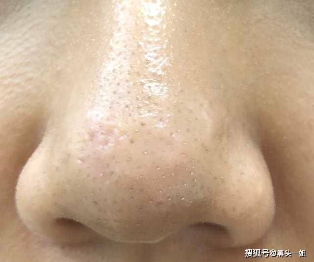 什么是黑头?什么是白头?什么是粉刺?什么是开放性粉刺?什么是闭口?
