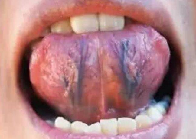 体内有癌舌头图片图片