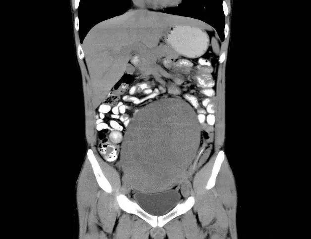 肠癌腹部包块位置图片图片