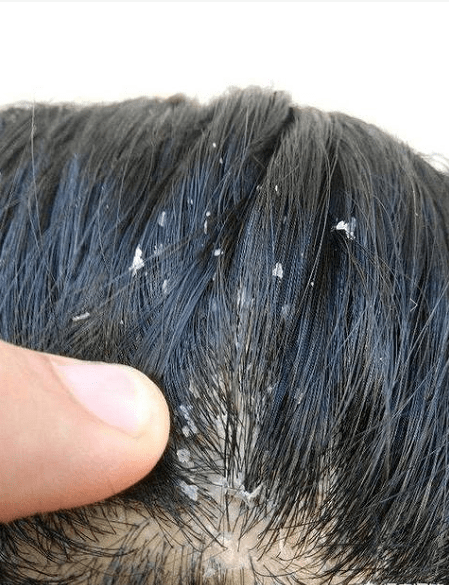 痒头皮屑的原因