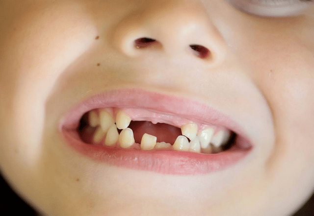 五岁半换牙正常吗图片