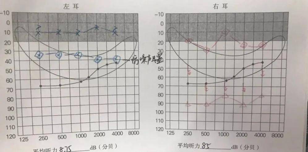 單耳聾干預快來看看哪種方式更適合自己或家人的聽力