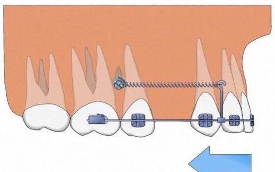关闭间隙在正畸治疗过程中,支抗钉的作用是不可小觑的,它就像船的锚
