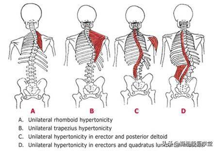 脊柱一侧肌肉凸起图片