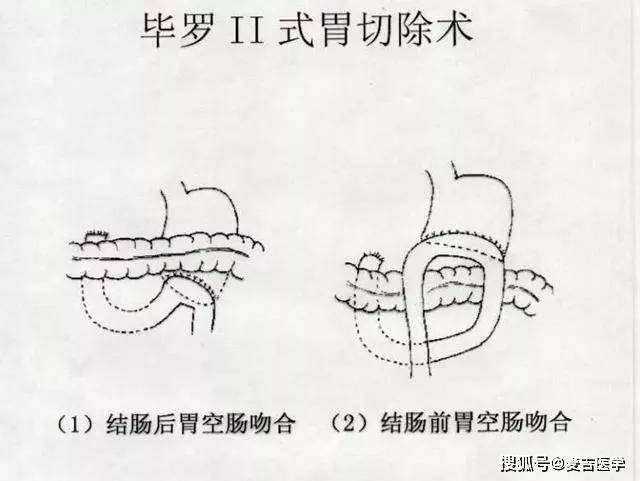 食管空肠吻合术示意图图片