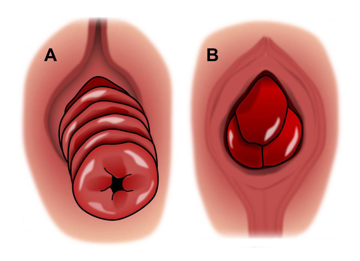 也就是我们常说的脱肛,是指直肠黏膜,肛管,直肠和乙状结肠向下移位