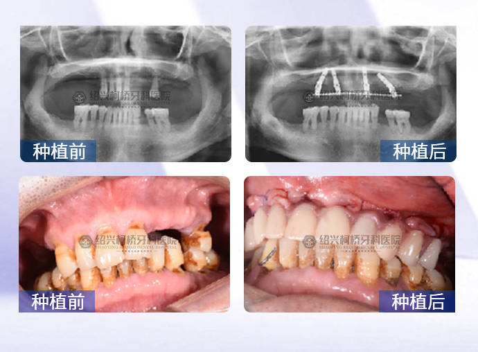 種植牙的這幾個誤區,你踩雷了嗎?(上)_都得種