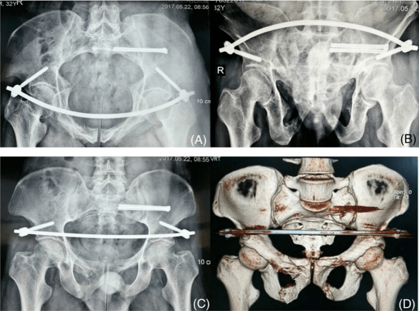 结论:tirobot辅助经皮骶髂关节置钉及髂前下棘椎弓根置钉是准确且微创