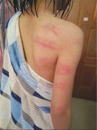 幼儿老师变身容嬷嬷孩子身上片片淤青妈妈痛哭我有责任