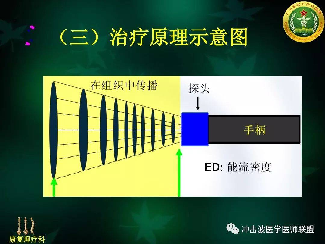 气动弹道式体外冲击波临床应用