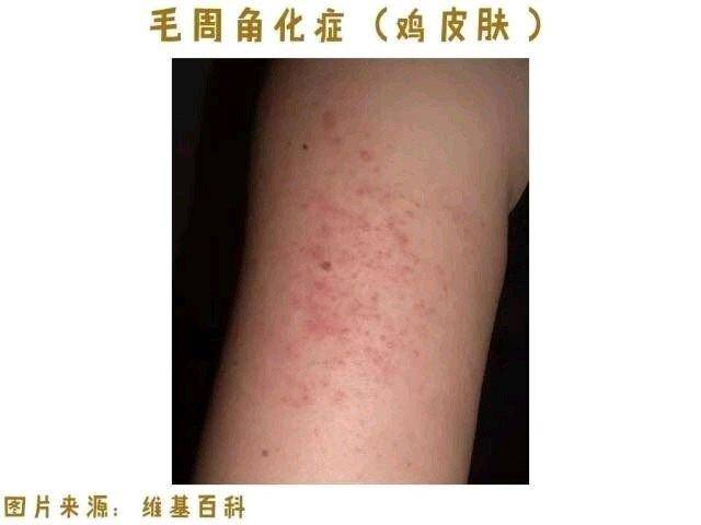 鸡皮肤大面积刷酸用什么(鸡皮肤可以通过刷酸治疗吗)