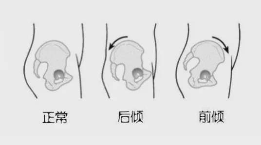 前凸后翘的人,可能是「骨盆倾斜」了,教你几个动作纠正改善